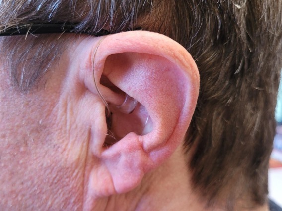 Image of adult ear with hearing aid
