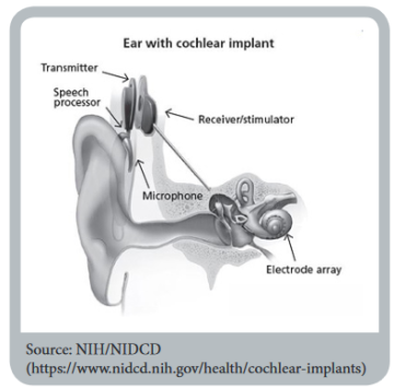 image of ear with cochlear implant